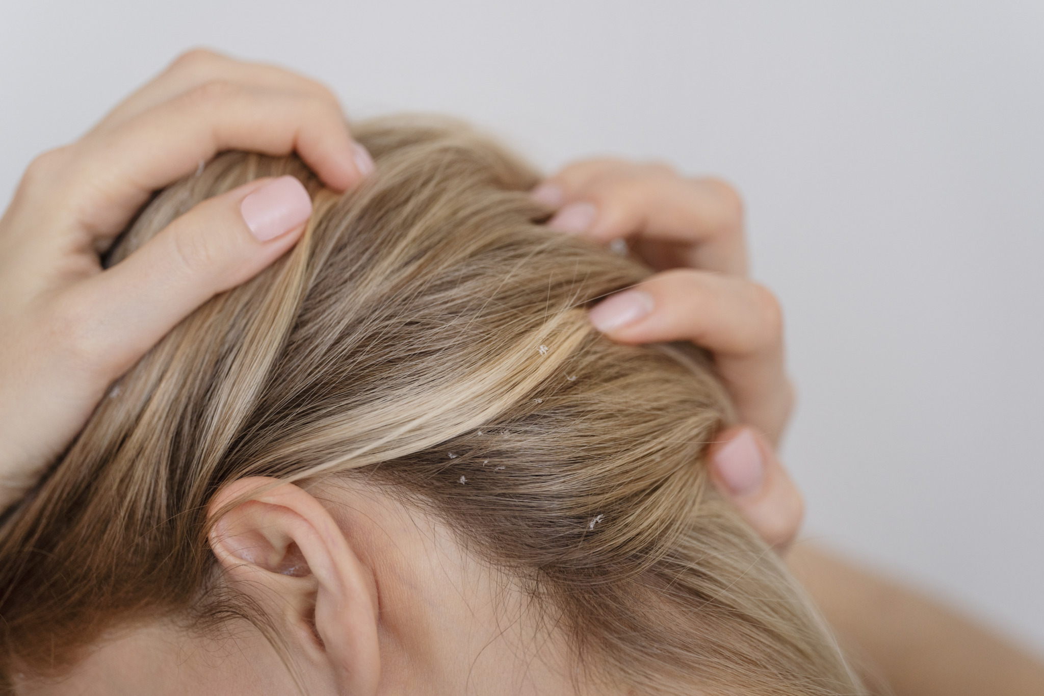 woman-with-dandruff-issues-close-up